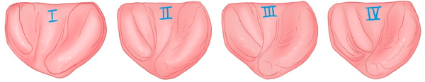 Положение фрагментов альвеолярного отростка у младеницев с односторонней расщелиной